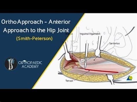 Hip Anterior Approach (Smith.